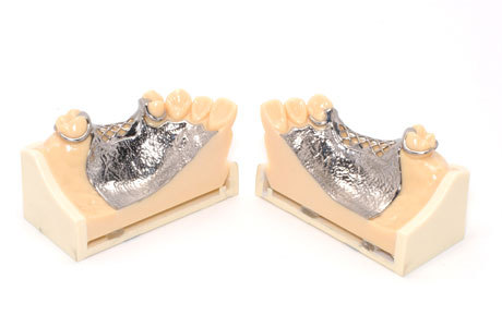 須山歯研のチタン鋳造