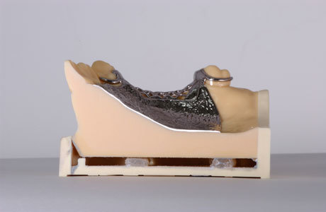 須山歯研のチタン鋳造