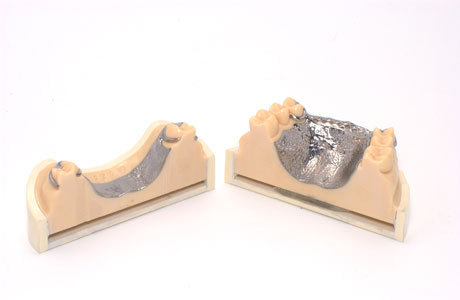 須山歯研のチタン鋳造