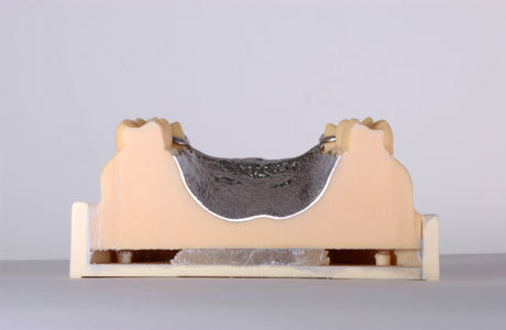 須山歯研のチタン鋳造